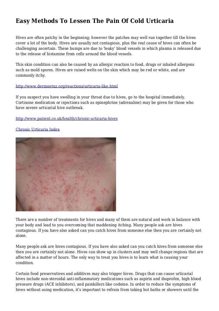 Cold urticaria: symptoms and treatment with medicines and folk remedies 80 Cold urticaria: symptoms and treatment with medicines and folk remedies 55